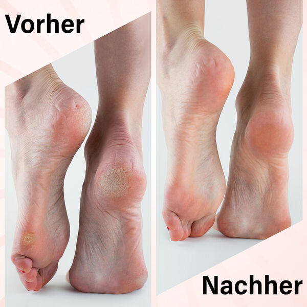 Elektrische Hornhautfeile, wei&szlig; image number 4